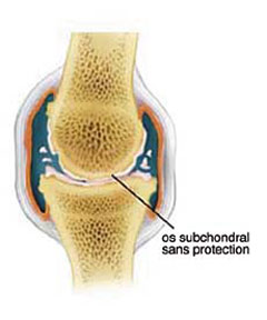 Articulation d’un cheval dans le stafe final de l’arthrose. Les extrémités de l’os frottant directement l'un contre l’autre.